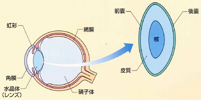 レーザー白内障手術