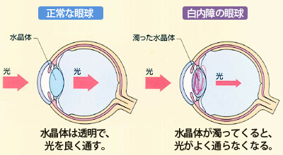 レーザー白内障手術