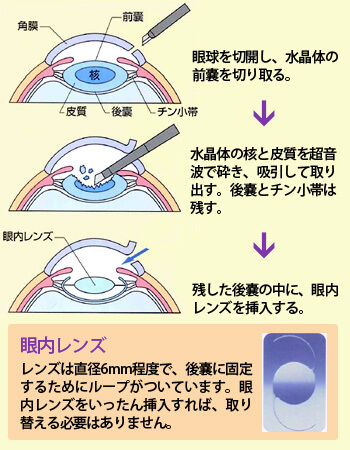 レーザー白内障手術