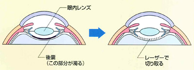 レーザー白内障手術