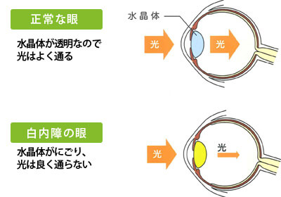 多焦点眼内レンズ（先進医療）